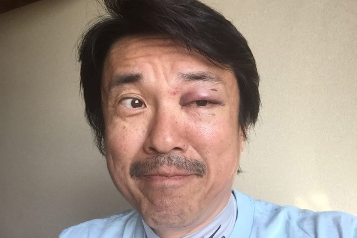 草野球の練習中、フライを取り損ねてボールを左目に当ててしまった。瞳孔の閉じが悪化し、徐々にドライアイも進行したらしい。