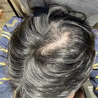 2026年2月下旬に撮影した私の頭頂部。この時点では地肌がしっかりと目立っている。